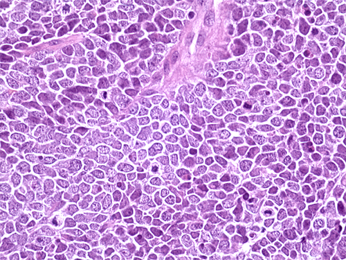 Hematoxylin and eosin staining of a tissue section from a Merkel cell carcinoma tumor.