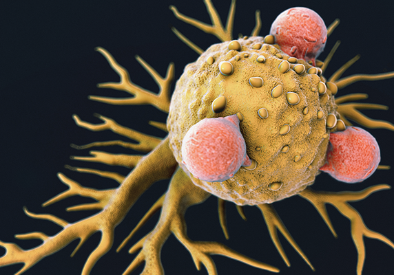 Scanning electron micrograph of T lymphocyte cells attached to a cancer cell.