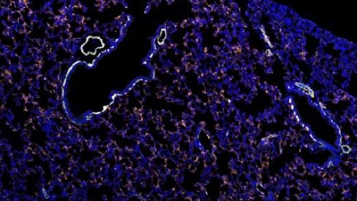 Early changes that occur in the lung in response to a localized primary tumor distant from the lung