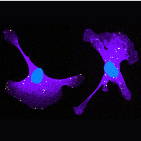 Breast cancer cells