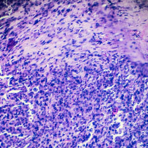 Rhabdomyosarcoma biopsy 