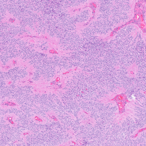 ependymoma