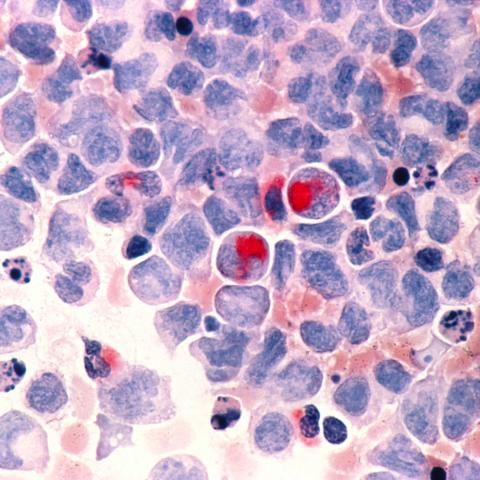 Acute myelocytic leukemia