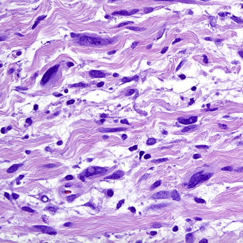 H&E stain of plexiform neurofibroma