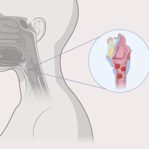 An illustration of papillomas in the throat