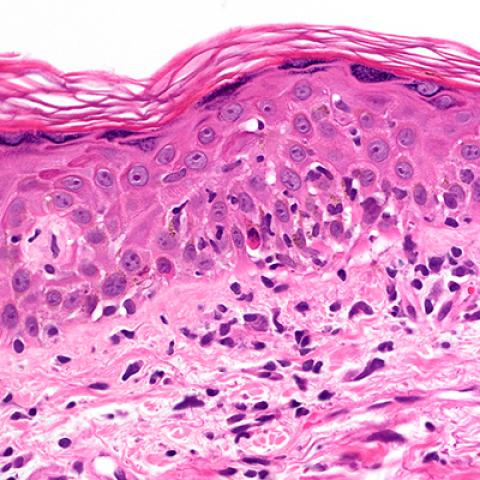 Photomicrograph showing graft-versus-host disease in the skin