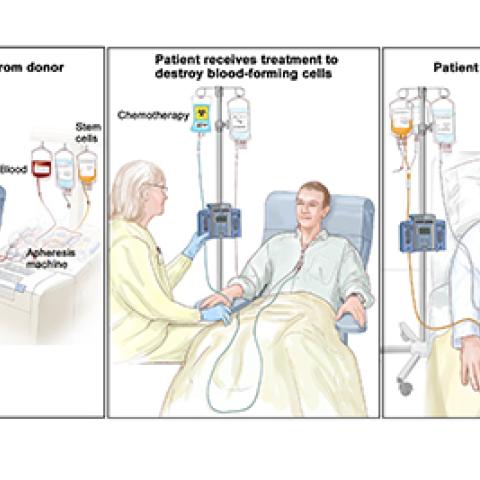 Stem cell transplant process