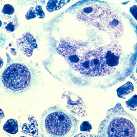 lymphoma cells