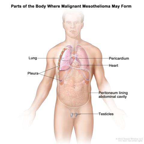 Malignant Mesothelioma