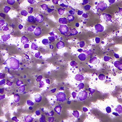 Micrograph of a diffuse large B cell lymphoma