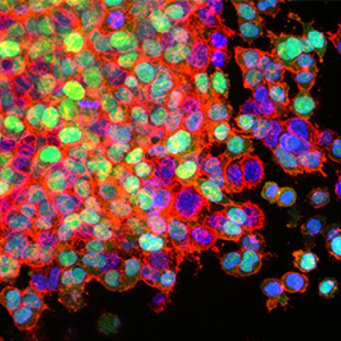 Lung cancer metastasis