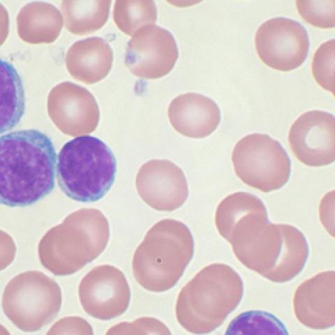 Chronic lymphocytic leukemia cells