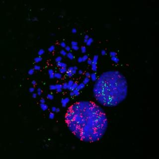 Lung cancer cells fluorescently labeled for MYC (red), MYCL (green) and chromosomes (blue) to identify MYC- and MYCL-positive ecDNA in the cells.