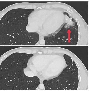 metastatic tumor CT