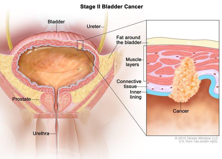 Muscle-invasive bladder cancer