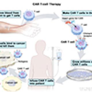 CAR T-cell therapy