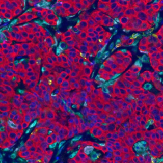 A collection of cancer cells surrounded by immune cells