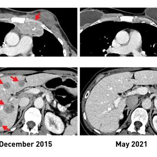 Scans of a woman with breast cancer before and after TIL therapy.