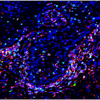 Microscopic image of oral chronic graft-versus-host disease