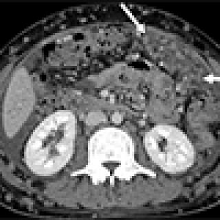 Peritoneal carcinomatosis