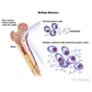 Multiple myeloma