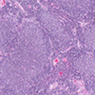 Follicular lymphoma