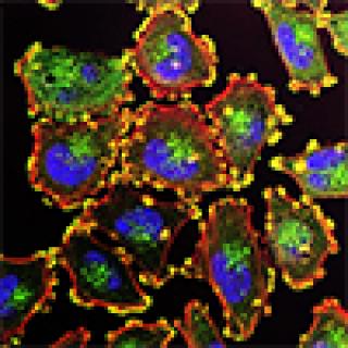 metastatic melanoma cells