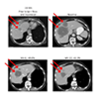 CT abdomen