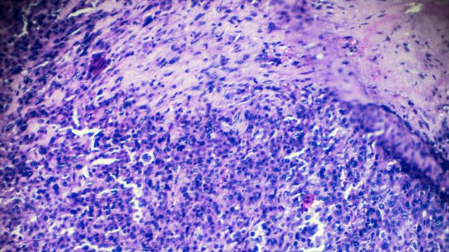 Rhabdomyosarcoma biopsy 