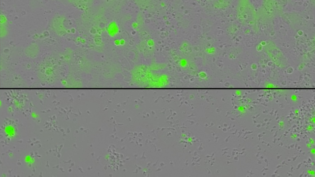 Tumor cells