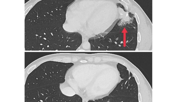 metastatic tumor CT