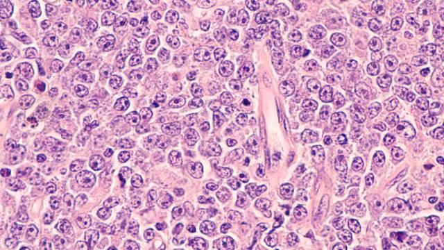 Photomicrograph of a diffuse large B-cell lymphoma (DLBCL)