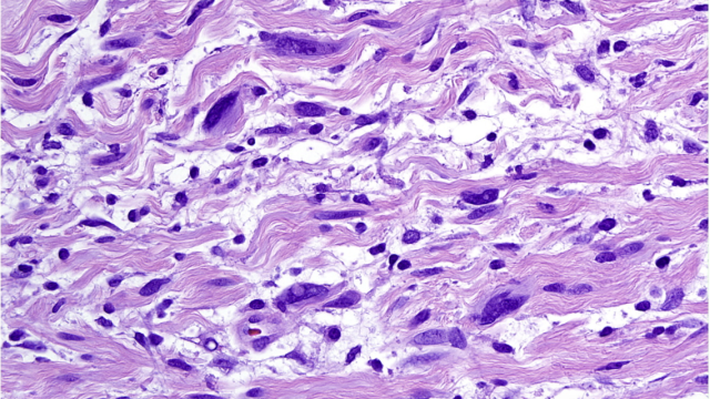 H&E stain of plexiform neurofibroma