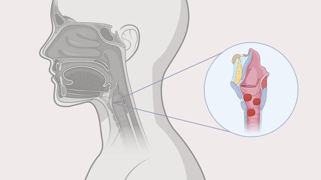 An illustration of papillomas in the throat