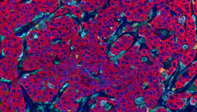 A collection of cancer cells surrounded by immune cells