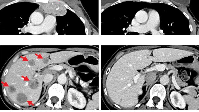 Scans of a woman with breast cancer before and after TIL therapy.