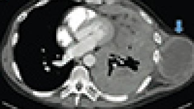 CT scan of a patient with mesothelioma