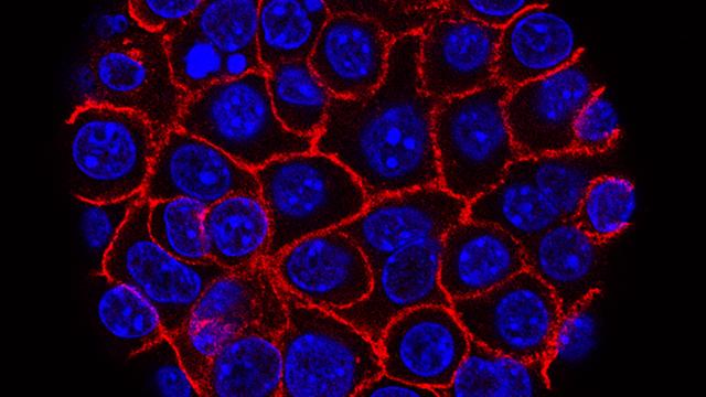 Pancreatic Cancer Cells