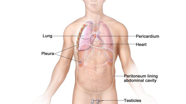 Malignant Mesothelioma