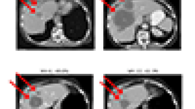 CT abdomen