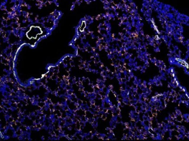 This image represents the early changes that occur in the lung in response to a localized primary tumor distant from the lung. 