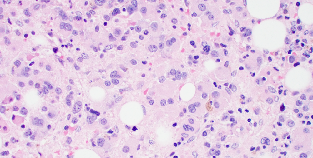 Core biopsy H&E of dysplastic megakaryocites.