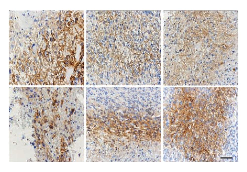 Microscopy images showing the prevalence of the protein CAIX in human glioblastoma