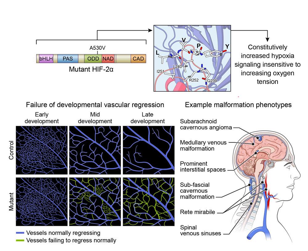 Illustration explaining the genetic mutation that causes Pacak-Zhuang syndrome, the increased vessel growth that ensues, and examples of malformation phenotypes