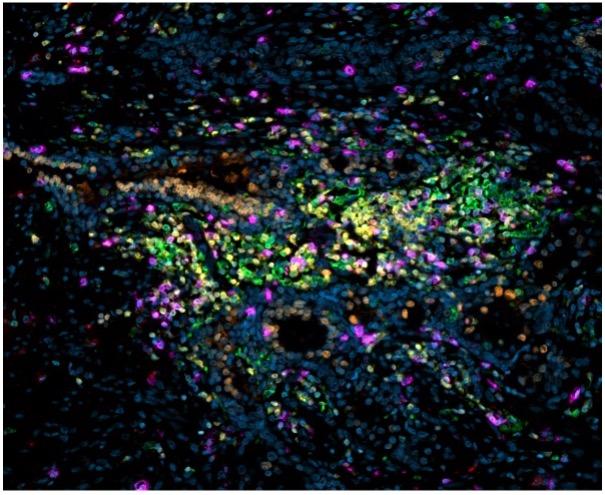 Patient whole-mount prostate stained for CD8 (purple), FoxP3 (red), TCF1 (orange), MHC-II (green), CD4 (yellow), and DAPI (blue).