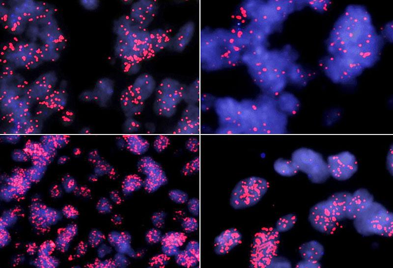 Microscopy images of four different MYCN amplified ependymomas. 