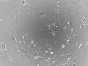 Picture 7 - Rhabdomyosarcoma (muscle tumor) cell line that has been treated with an experimental agent